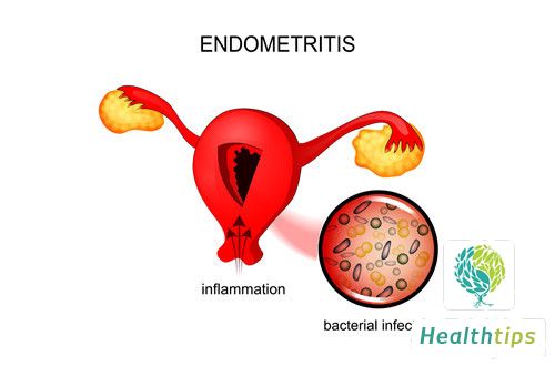 What Are the Differences Between Uterine Fibroids and Uterine Polyps?