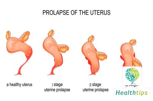 What Are the Dietary Considerations After Undergoing a Uterine Polyp Surgery?