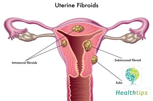 Does Uterine Fibroids Cause Abdominal Distension?