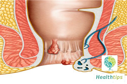 What Is a Prolapsed Mixed Hemorrhoid?