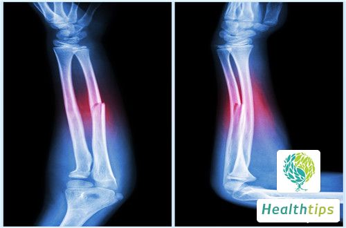 How Long Can a Person Survive with Early-Stage Osteosarcoma?