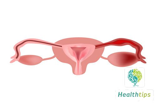 What Are the Key Differences Between Ovarian Cancer and Ovarian Cysts?