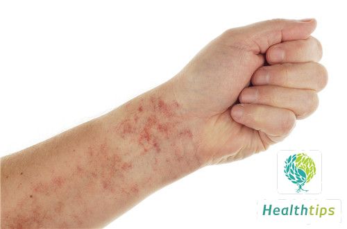 How to Treat Allergic Purpura Rash?