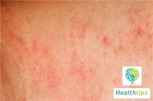 What Are the Early Symptoms of Subacute Cutaneous Lupus Erythematosus?