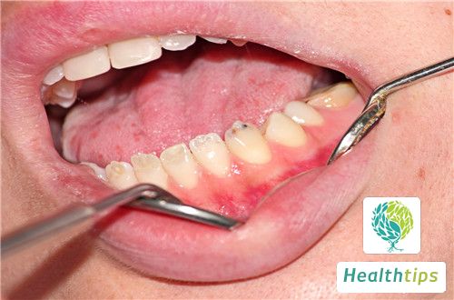 How to Deal with Gum Ulceration?