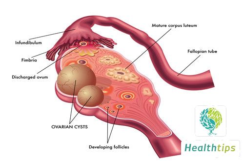 Is a Small Ovarian Cyst a Serious Condition?