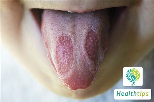 Why Do I Have Painful Bumps on the Side of My Tongues Root?