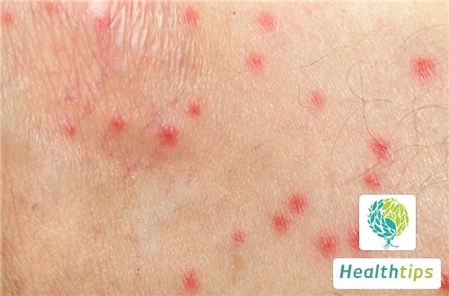 Why Do Red Spots Appear on the Human Body?