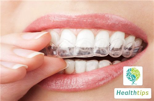 At What Age Can a Person Wear Dental Braces?