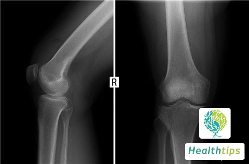 What Are the Causes of Elevated Bone Mineral Content?