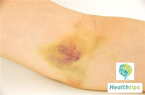 Why Are Bruises Easy to Appear on the Body? What Nutrient Could Be Lacking?