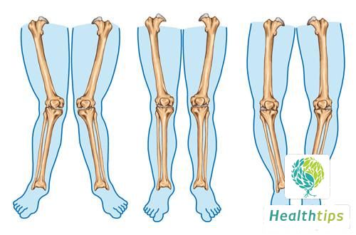 What Are Some Tips for Correcting Childrens O-Legs?