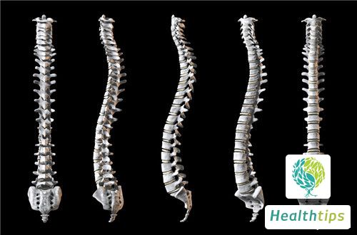 What Should I Do If My Spine Is Not Straight?