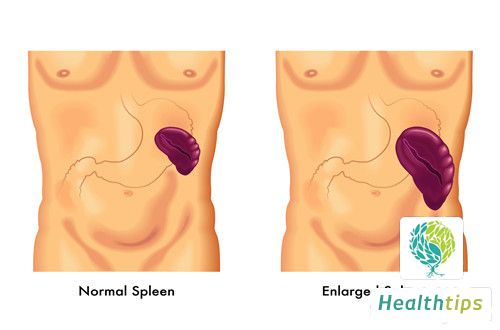 How to Treat Splenomegaly?