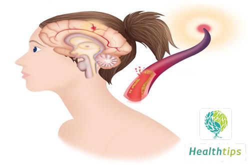 What Are the Medications Used to Treat Sequelae of Cerebral Hemorrhage?