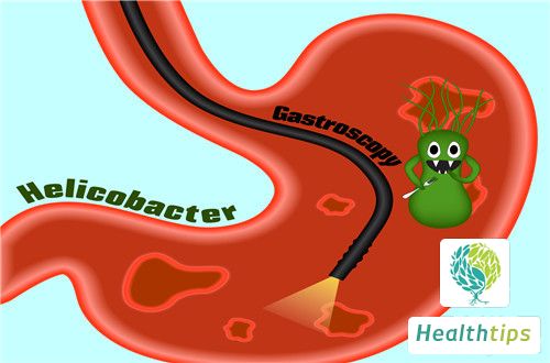 Why Do Polyps Develop in the Stomach?