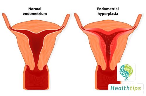 What Are the Risks of Uterine Lining Thickening and How to Prevent It?