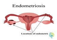 What are the Effects of Leuprolide Microsphere Injection?