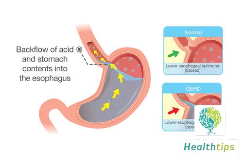 What Are the Possible Causes of a Lump on the Gastric Fundus?