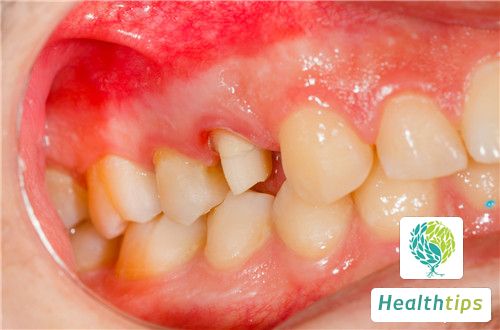 What should I do if I have a transparent bubble on my gums?