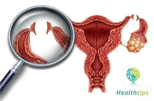 What Are the Considerations for Performing a Hysteroscopy Tubal Recanalization Surgery?