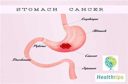 How to Recognize and Treat the Symptoms of Gastric Tumors?