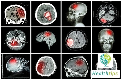 How long does it take for a brain hematoma to be absorbed?