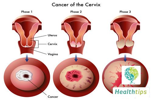 What does CIN lesion mean?