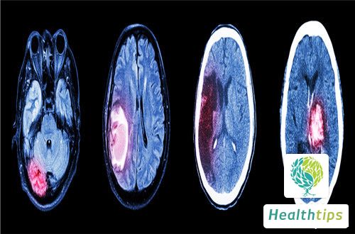 What are the potential after-effects of a cerebral hemorrhage?