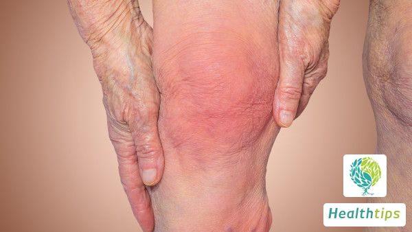 Is Heel Pain Always a Sign of Gout?