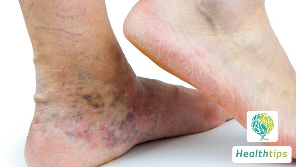 How to Relieve the Pain When Gout Flares Up?