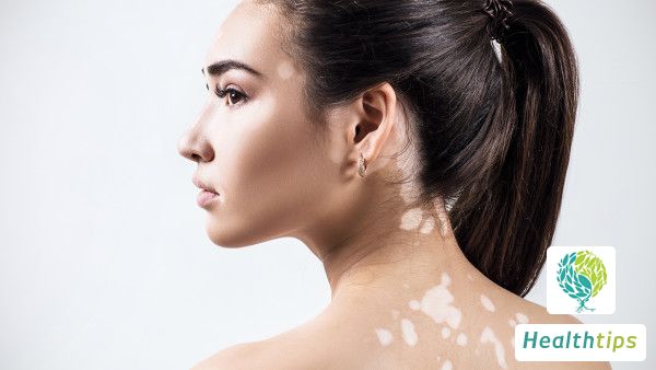 How Should I Properly Care for My Vitiligo Condition?