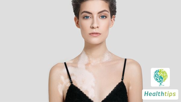 What Should I Do About Vitiligo on My Head?