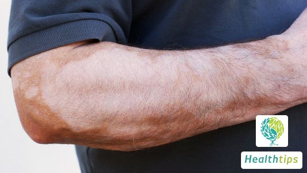 When is it prone to developing vitiligo?