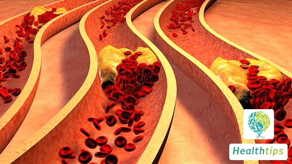 How to Adjust Your Diet After a Stroke?