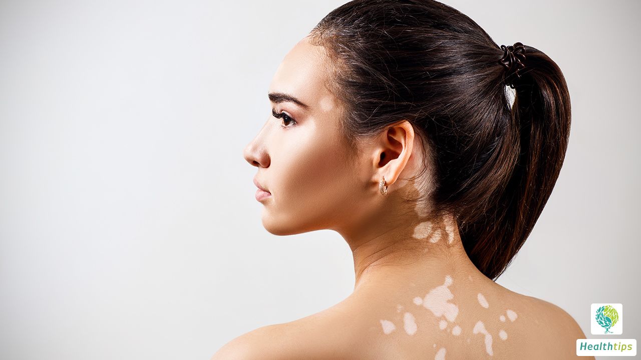 Why is It Difficult to Cure Vitiligo Over a Prolonged Period of Time?