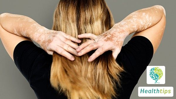 What are the main symptoms of vitiligo?