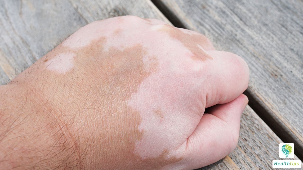 Does vitiligo transmit through blood?