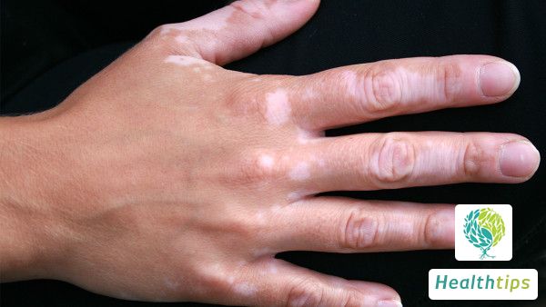 How much does it cost to cure vitiligo?