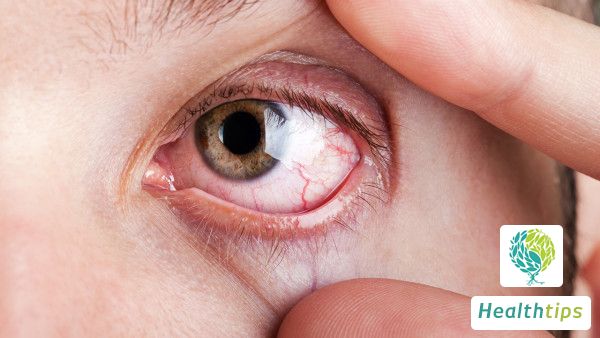 Can orbital fracture lead to dry eye syndrome?