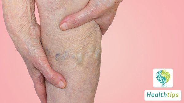 Can severe gout lead to paralysis?