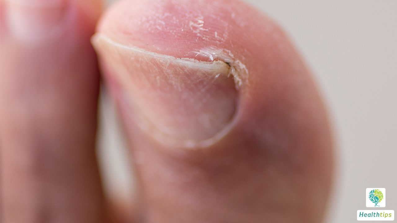 Where can I find treatment for nail fungus in Xuyi?