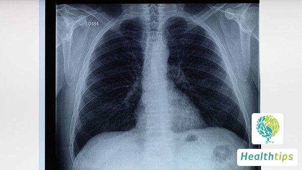 Is Pulmonary Tuberculosis Recurrence Highly Contagious?