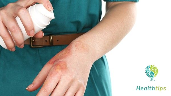 What Are the Three Major Taboos After a Burn Injury?