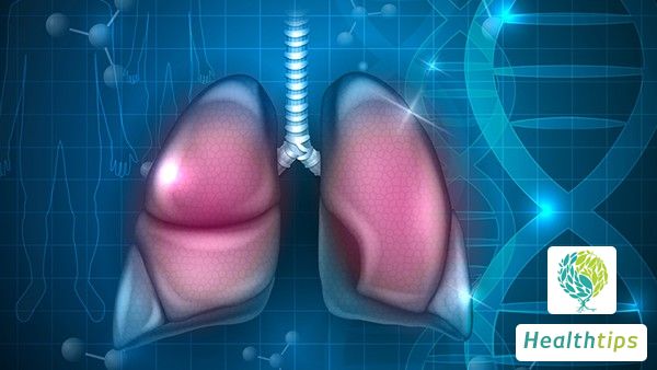 Should Treatment Still Be Pursued in Late-Stage Lung Cancer?