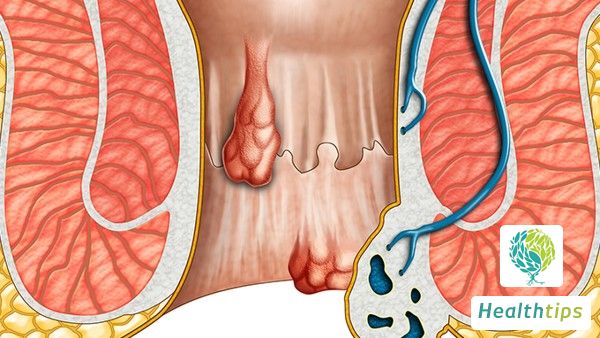 What Causes Diarrhea-Induced Hypokalemia?