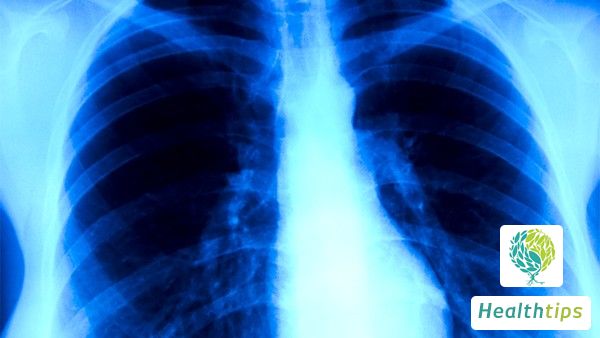 Can tuberculosis lead to lung necrosis?