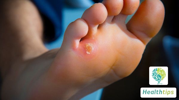 How Should I Deal with a Corn on My Big Toe?