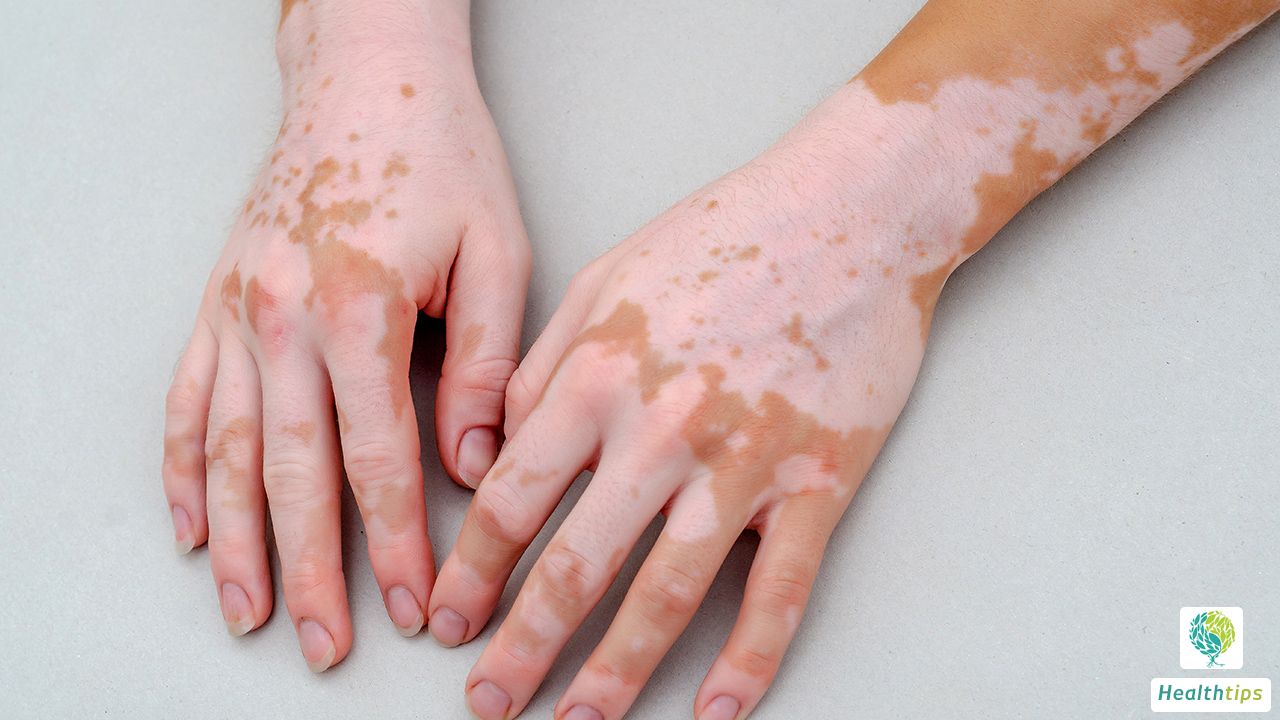 Why Does One Develop Vitiligo on the Feet?