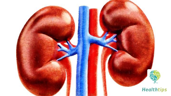 What are the dietary approaches for managing kidney stones?